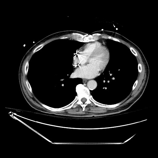 File:Closed loop obstruction due to adhesive band, resulting in small bowel ischemia and resection (Radiopaedia 83835-99023 D 6).jpg