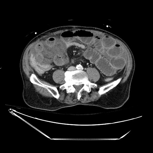 Closed loop obstruction due to adhesive band, resulting in small bowel ischemia and resection (Radiopaedia 83835-99023 D 96).jpg