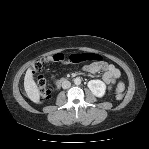File:Closed loop small bowel obstruction (Radiopaedia 65403-74451 A 40).jpg
