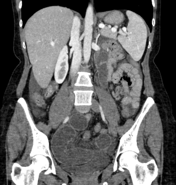 Closed loop small bowel obstruction (Radiopaedia 71211-81508 B 67).jpg