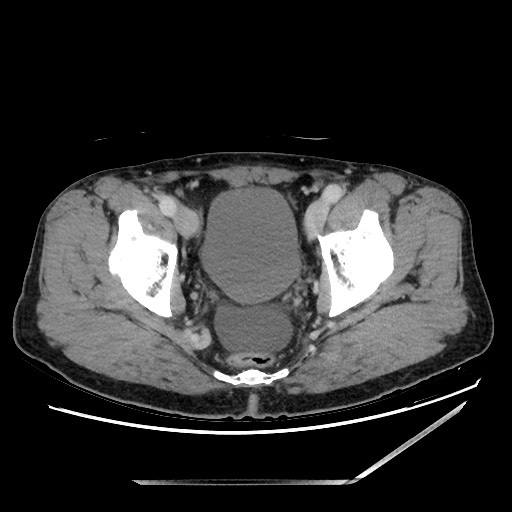 File:Closed loop small bowel obstruction - omental adhesion causing "internal hernia" (Radiopaedia 85129-100682 A 152).jpg