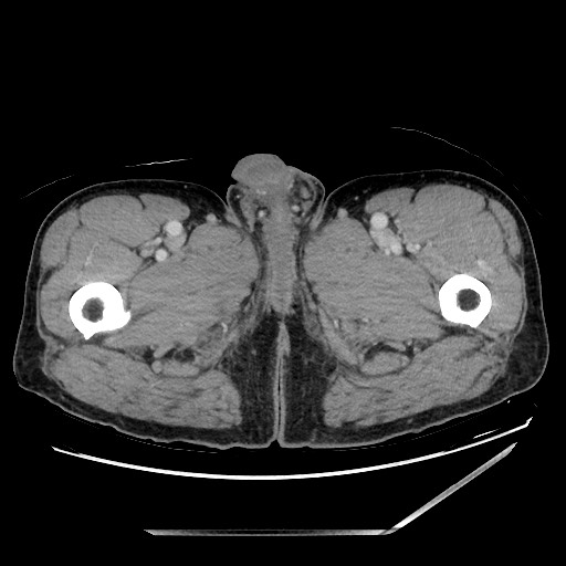Closed loop small bowel obstruction - omental adhesion causing "internal hernia" (Radiopaedia 85129-100682 A 194).jpg