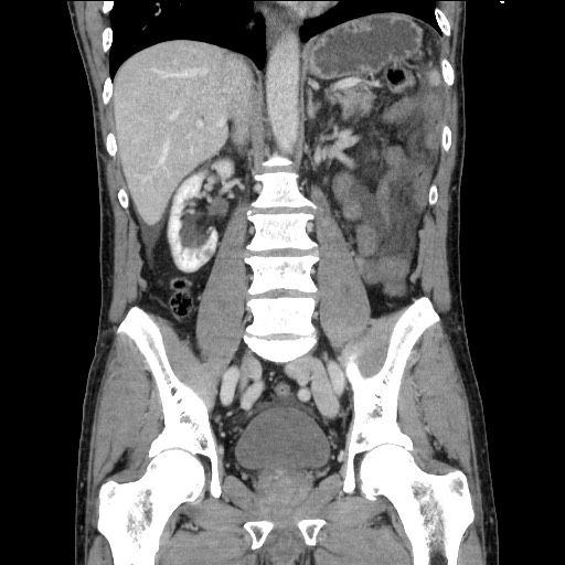 Closed loop small bowel obstruction - omental adhesion causing "internal hernia" (Radiopaedia 85129-100682 B 76).jpg