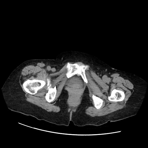 File:Closed loop small bowel obstruction due to adhesive band, with intramural hemorrhage and ischemia (Radiopaedia 83831-99017 Axial non-contrast 162).jpg