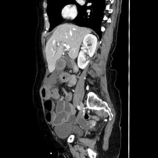 Closed loop small bowel obstruction due to adhesive band, with intramural hemorrhage and ischemia (Radiopaedia 83831-99017 D 83).jpg