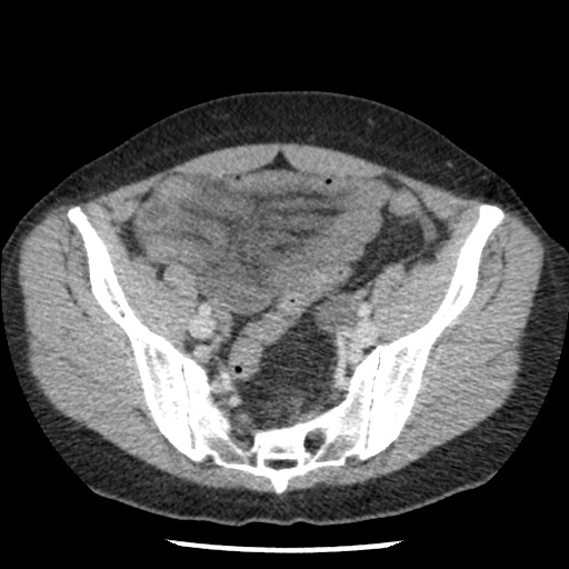 Closed loop small bowel obstruction due to trans-omental herniation (Radiopaedia 35593-37109 A 68).jpg