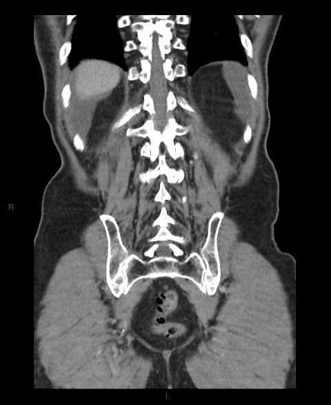 Closed loop small bowel obstruction with ischemia (Radiopaedia 84180-99456 B 10).jpg
