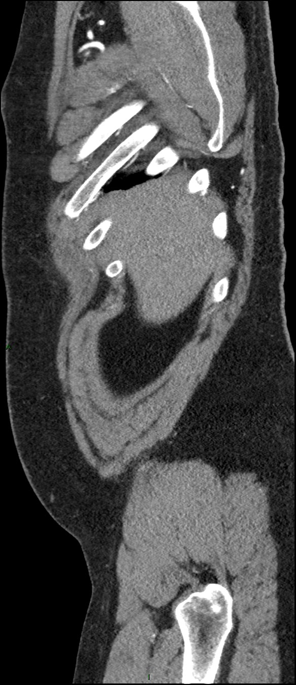 Coarctation of the aorta (Radiopaedia 74632-88521 C 22).jpg
