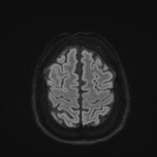 Cochlear incomplete partition type III associated with hypothalamic hamartoma (Radiopaedia 88756-105498 Axial DWI 75).jpg