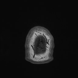 File:Cochlear incomplete partition type III associated with hypothalamic hamartoma (Radiopaedia 88756-105498 Axial T1 193).jpg