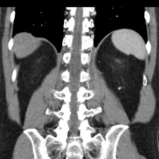 File:Collateral circulation following left renal vein thrombosis (Radiopaedia 17319-17013 renal cortical phase 1).jpg