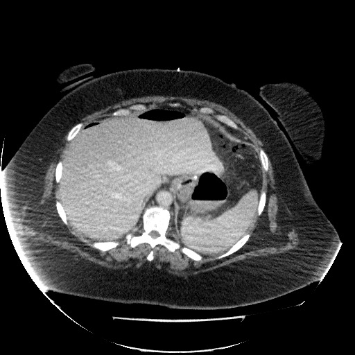 File:Collection due to leak after sleeve gastrectomy (Radiopaedia 55504-61972 A 19).jpg