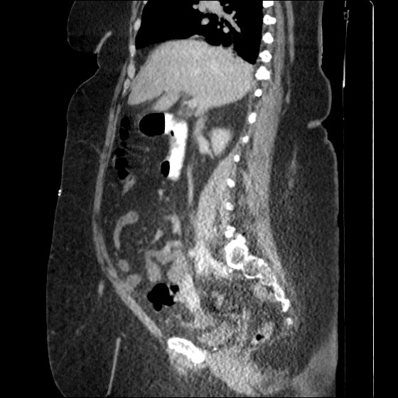 File:Collection due to leak after sleeve gastrectomy (Radiopaedia 55504-61972 C 40).jpg