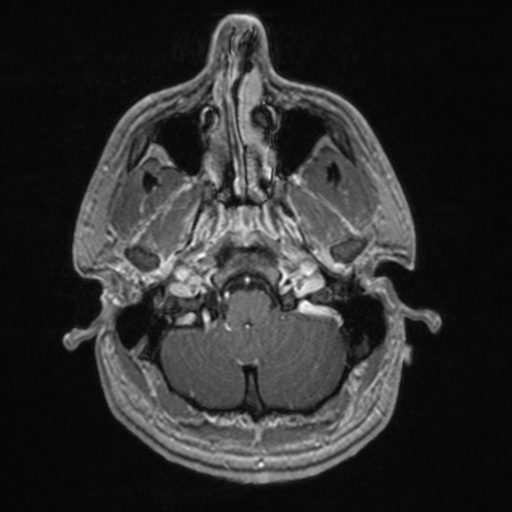 File:Colloid cyst (Radiopaedia 44510-48181 Axial T1 C+ 37).png