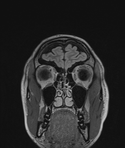 Colloid cyst (Radiopaedia 73154-83877 Coronal FLAIR 9).jpg