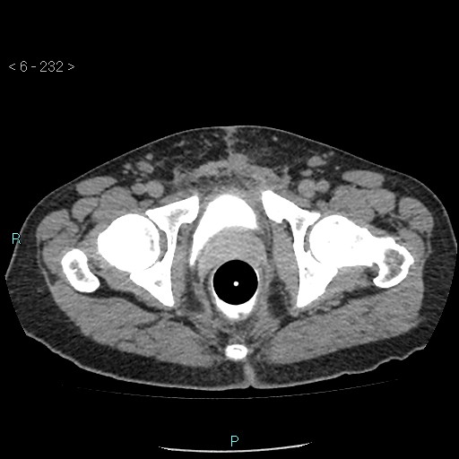 Colo-cutaneous fistula (Radiopaedia 40531-43129 A 97).jpg