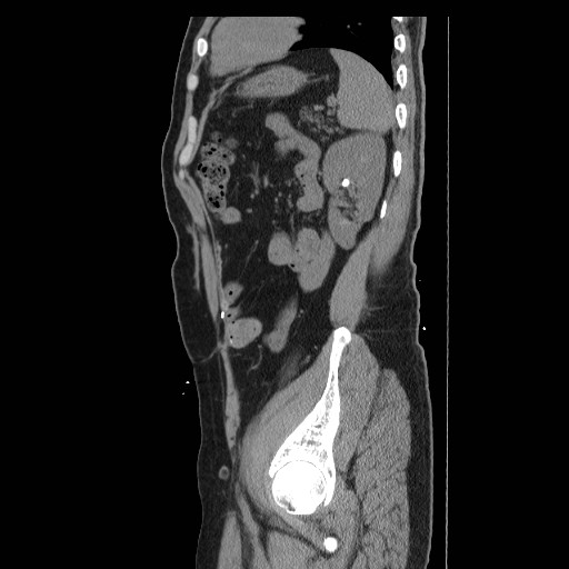 File:Colocutaneous fistula in Crohn's disease (Radiopaedia 29586-30093 C 48).jpg