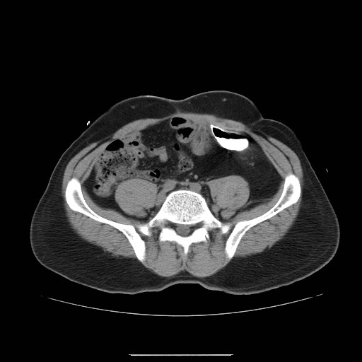 File:Colocutaneous fistula in Crohn's disease (Radiopaedia 29586-30093 D 20).jpg