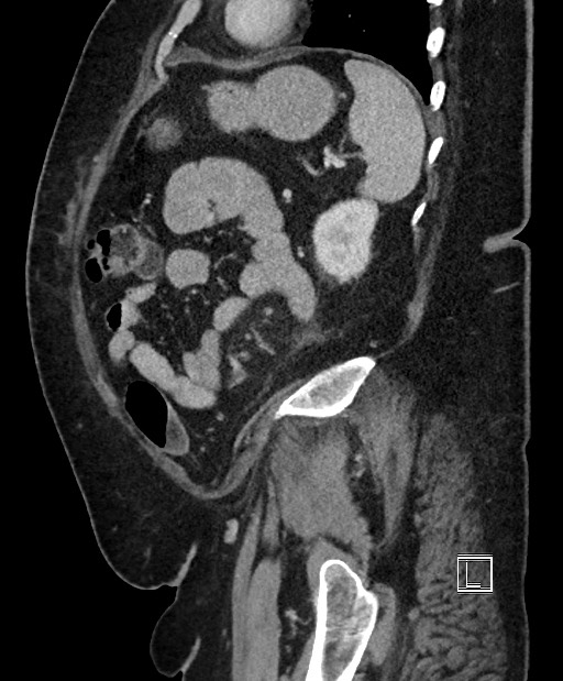 Colon adenocarcinoma (Radiopaedia 59374-66735 C 19).jpg