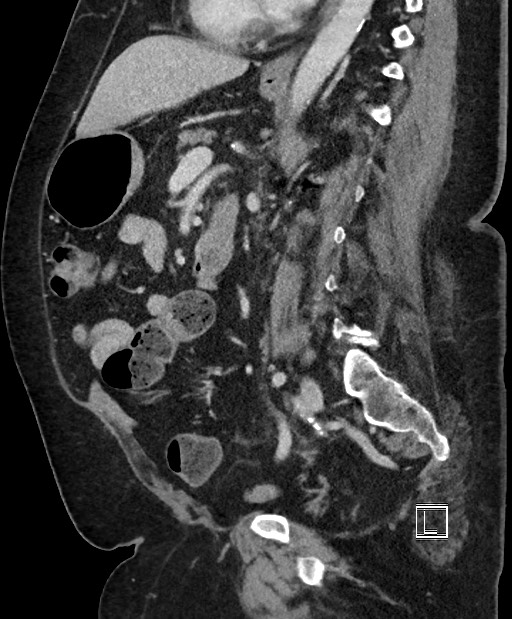 Colon adenocarcinoma (Radiopaedia 59374-66735 C 32).jpg