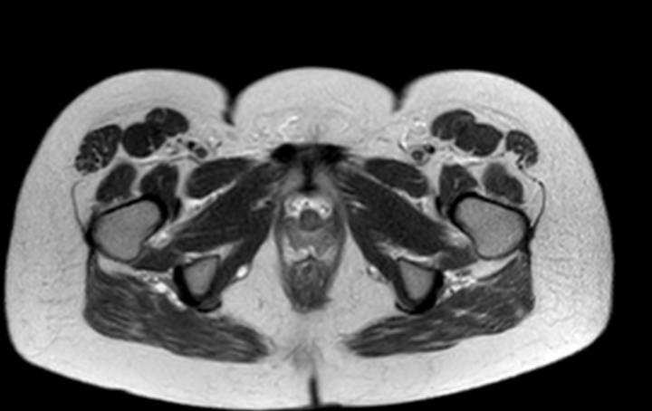 Colon adenocarcinoma with Krukenberg tumors, advanced pregnancy (Radiopaedia 67279-76645 Axial T2 1).jpg