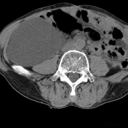 Colon cancer with calcified liver metastasis (Radiopaedia 74423-85309 Axial non-contrast 62).jpg