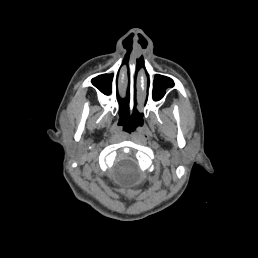 Nasal pyogenic granuloma (lobular capillary hemangioma) (Radiopaedia 85536-101244 Axial non-contrast 15).jpg