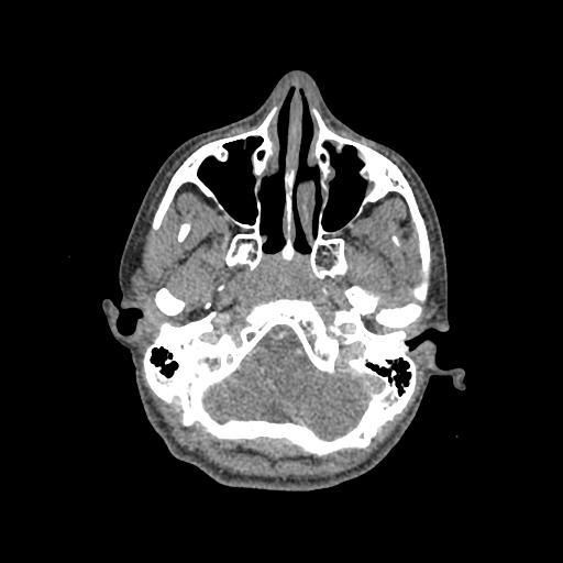 Nasal pyogenic granuloma (lobular capillary hemangioma) (Radiopaedia 85536-101244 C 67).jpg
