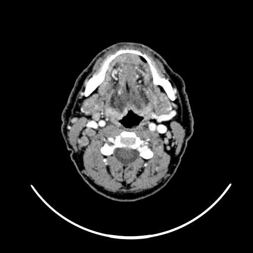 File:Nasopharyngeal carcinoma - infiltrating the clivus (Radiopaedia 62583-70875 Axial Post contrast 37).jpg