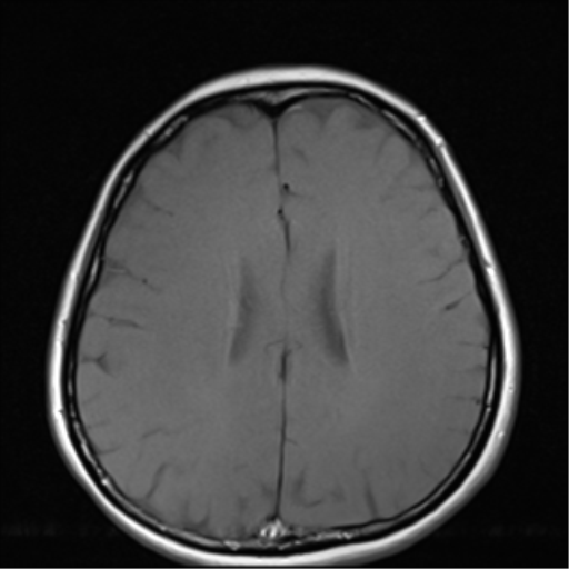 File:Nasopharyngeal carcinoma with cerebral abscess (Radiopaedia 43018-46273 Axial T1 1).png