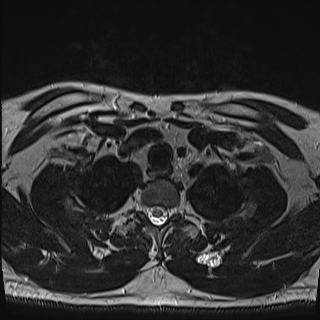 File:Nasopharyngeal carcinoma with perineural spread (Radiopaedia 55030-61380 Axial T2 85).jpg