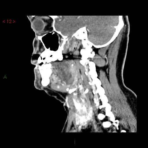 File:Nasopharyngeal lymphoma (Radiopaedia 54235-60432 B 3).jpg