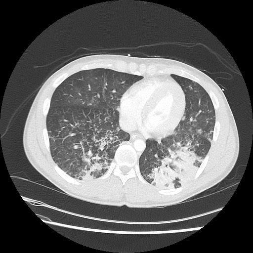 Near-drowning pulmonary edema (Radiopaedia 59457-66814 Axial lung window 41).jpg