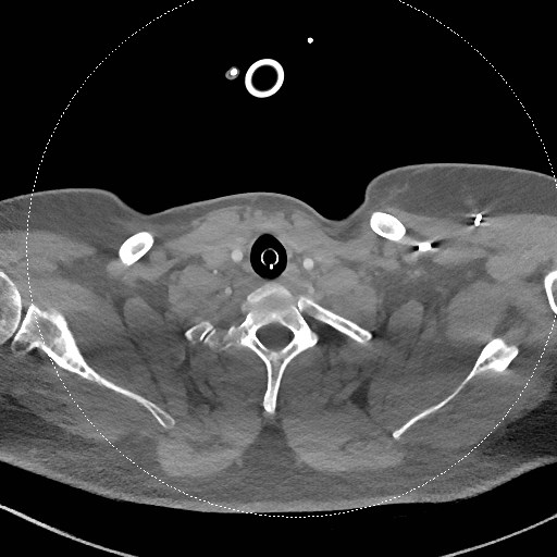 Neck CT angiogram (intraosseous vascular access) (Radiopaedia 55481-61945 B 116).jpg
