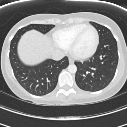 File:Necrobiotic pulmonary nodules - Crohn disease (Radiopaedia 20723-20631 Axial lung window 107).jpg