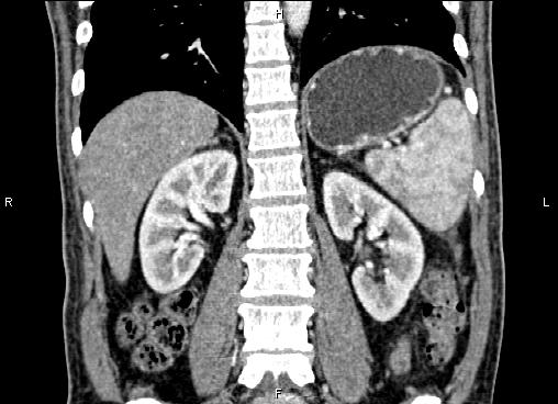 Necrotizing pancreatitis (Radiopaedia 87796-104248 F 47).jpg