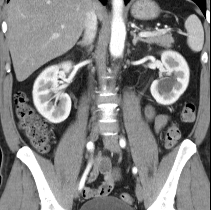 File:Necrotizing pancreatitis with acute necrotic collection (Radiopaedia 14470-14417 C 25).jpg