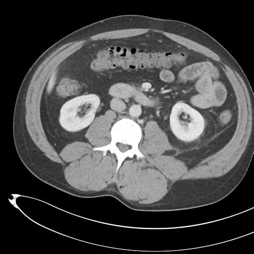 File:Necrotizing pancreatitis with acute necrotic collections (Radiopaedia 38829-41012 B 42).png