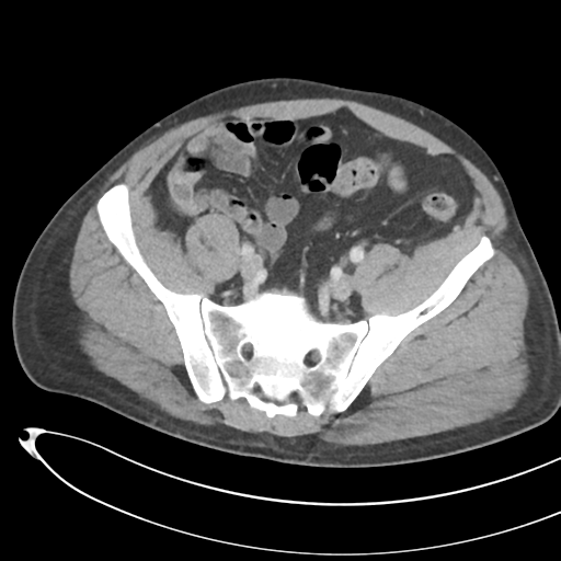 File:Necrotizing pancreatitis with acute necrotic collections (Radiopaedia 38829-41012 B 64).png