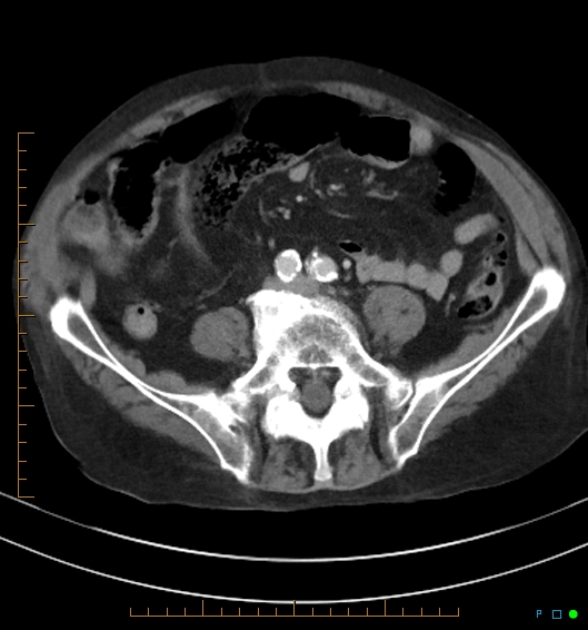 Necrotzing fasciitis due to a perforated adenocarcinoma of the splenic flexure (Radiopaedia 46930-51455 A 43).jpg