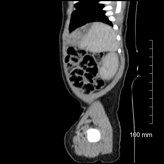 File:Neonatal neuroblastoma (Radiopaedia 56651-63438 C 21).jpg