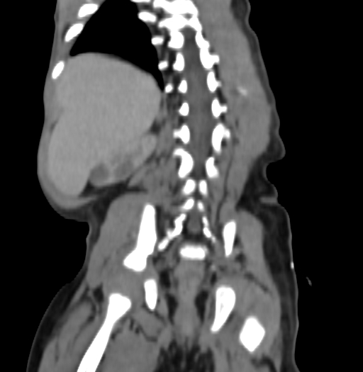 Nephroblastomatosis (Radiopaedia 71294-81607 B 273).jpg