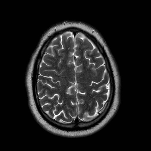 File:Neuro-Behcet's disease (Radiopaedia 21557-21506 Axial T2 22).jpg