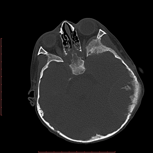 File:Neuroblastoma skull metastasis (Radiopaedia 56053-62683 Axial bone window 9).jpg