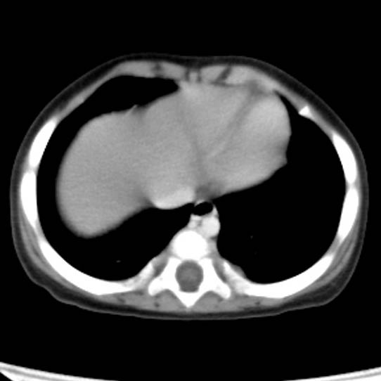 Neuroblastoma with skull metastases (Radiopaedia 30326-30960 C 1).jpg