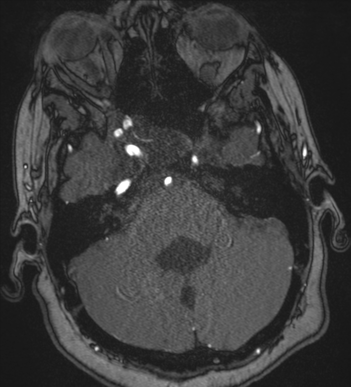 Neurofibromatosis type 1 - head and neck - CNS manifestations (Radiopaedia 49910-55188 Axial MRA 15).png