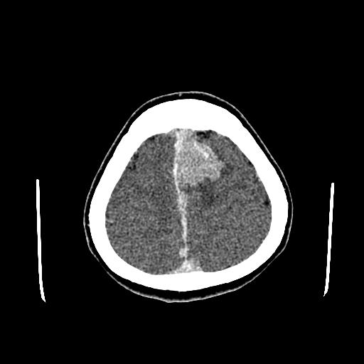 File:Neurofibromatosis type 2 (Radiopaedia 25389-25637 Axial C+ 85).jpg