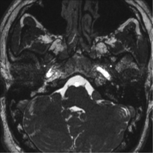 Neurofibromatosis type 2 (Radiopaedia 44936-48838 E 20).png