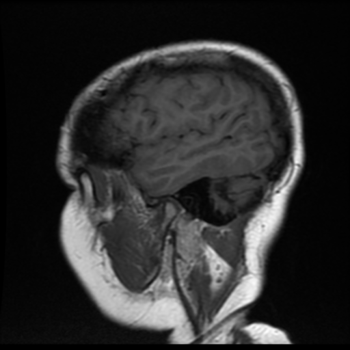 File:Neurofibromatosis type 2 (Radiopaedia 45229-49247 Sagittal T1 3).png