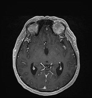 Neurofibromatosis type 2 (Radiopaedia 79097-92049 Axial T1 C+ 95).jpg